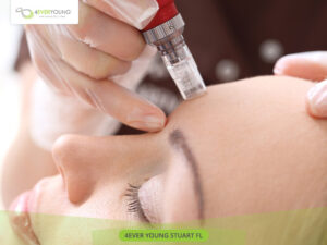 Microneedling Stuart FL