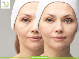 Non-Invasive Facelift Naples FL