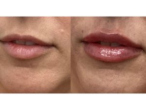 Lip Enhancement