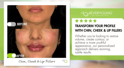 FACIAL BALANCING WITH DERMAL FILLER