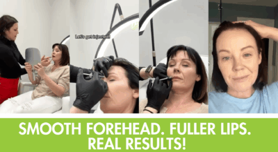 Botox Midlothian VA, lip flip Botox, forehead wrinkles Botox, natural Botox results, lip flip near me, Botox before and after Midlothian, best Botox injector Midlothian