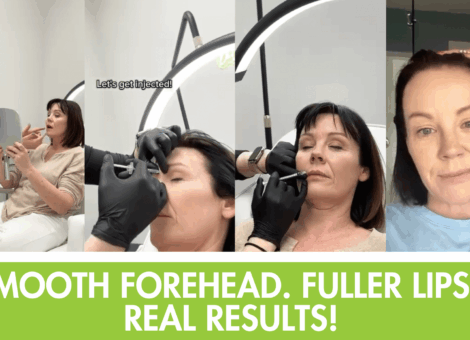 Botox Midlothian VA, lip flip Botox, forehead wrinkles Botox, natural Botox results, lip flip near me, Botox before and after Midlothian, best Botox injector Midlothian