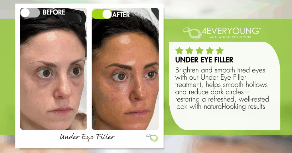 undereye filler