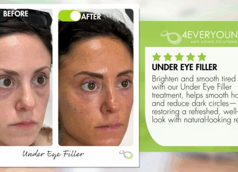 undereye filler