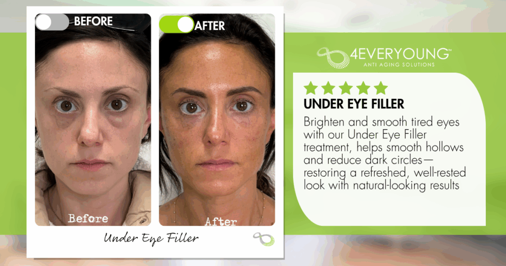 undereye filler