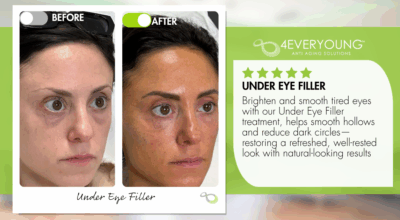 undereye filler