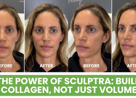 Sculptra Montvale collagen stimulator Montvale Sculptra near me Montvale biostimulator injectable Montvale Sculptra treatment Montvale NJ collagen building injections Montvale 4Ever Young Montvale aesthetics