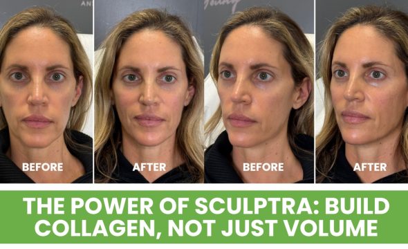  The Power of Sculptra in Montvale: Build Collagen, Not Just Volume 