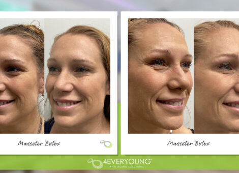MASSETER BOTOX IN MT. PLEASANT