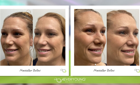  Masseter Botox: The Secret to a Slimmer Jawline 