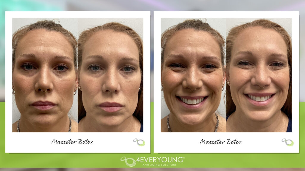 MASSETER BOTOX IN MT. PLEASANT