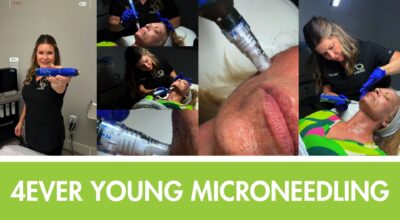 microneedling