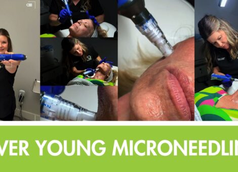 microneedling