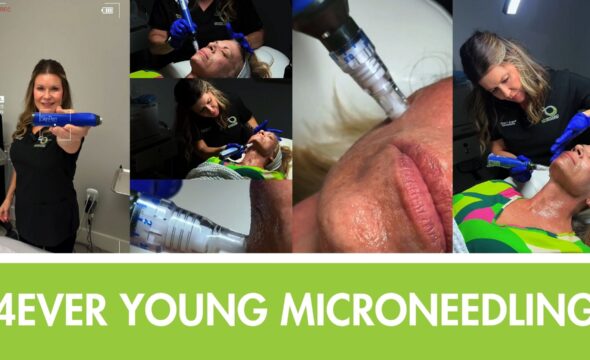  5 Benefits of Microneedling for Skin Rejuvenation 