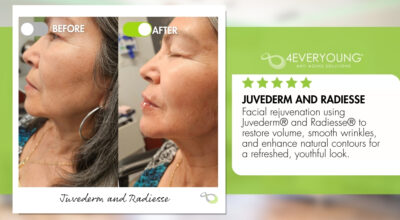 Juvederm Radiesse New Braunfels