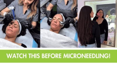 Microneedling New Braunfels