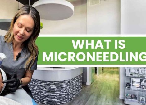 microneedling