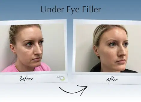 Under Eye Filler Newtown, PA