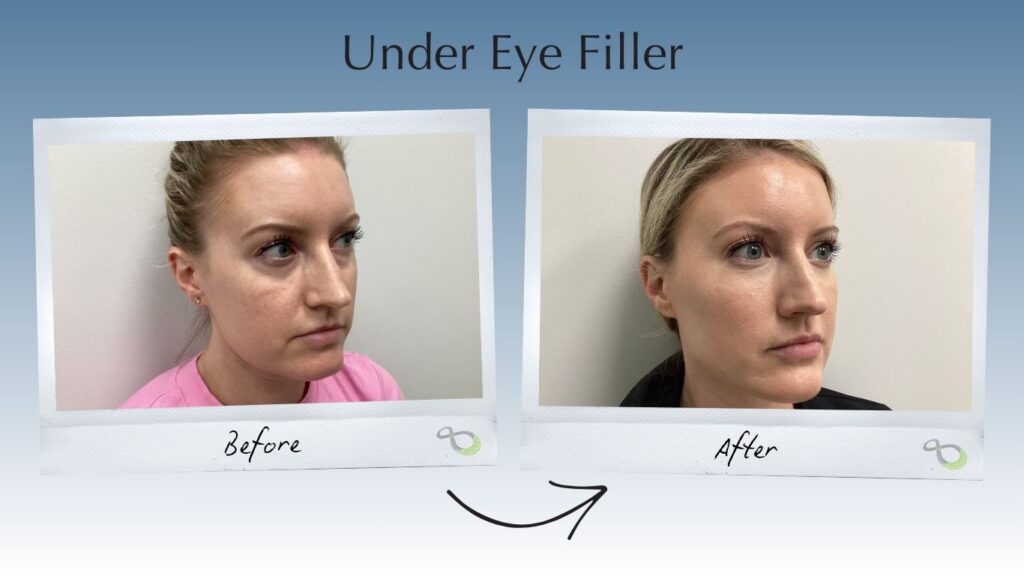 Under Eye Filler Newtown, PA