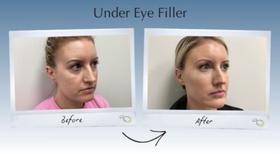 Under Eye Filler Newtown, PA