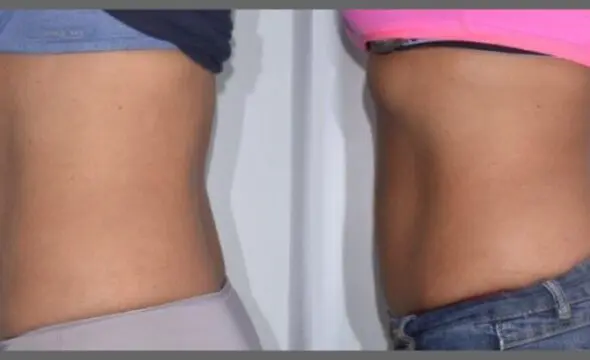 Body Contouring with Venus Bliss Max