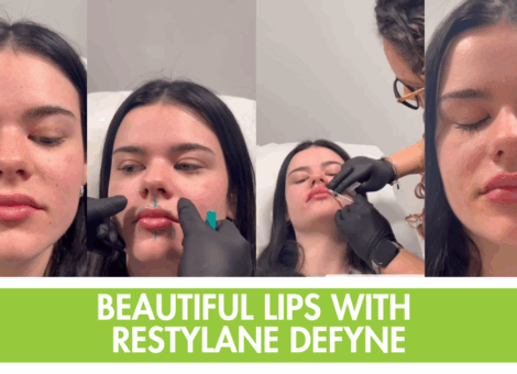 Beautiful lips with restylane defyne lip filler in parkland