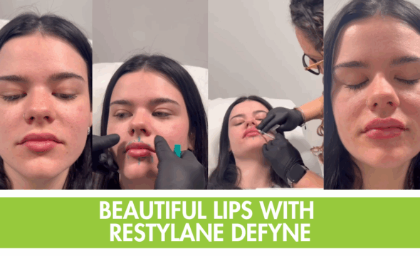  Beautiful Lips with Restylane Defyne: Lip Filler Trends for 2025 in Parkland 