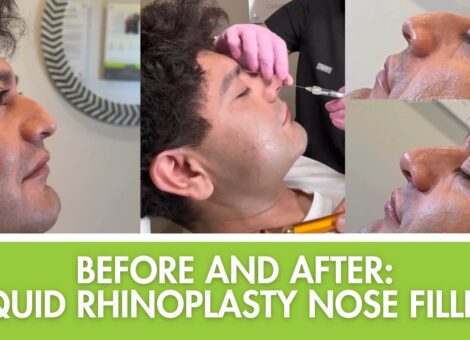 before-and-after-liquiid-rhinoplasty-nose-filler, liquid rhinoplasty Plantation FL, non-surgical nose job Broward, nose filler near me, best injector Plantation FL, profile balancing fillers, dermal fillers for nose Plantation