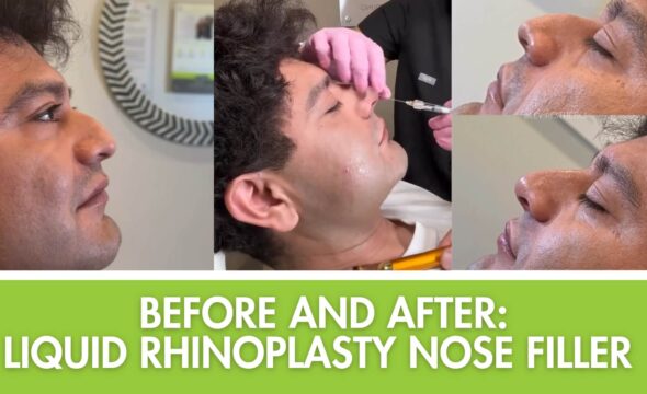  Liquid Rhinoplasty in Plantation, FL: The Non-Surgical Nose Job That’s Changing the Game 