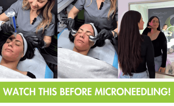  Not Just a Glow—Microneedling Builds Confidence That Lasts 