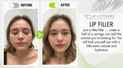 lip filler