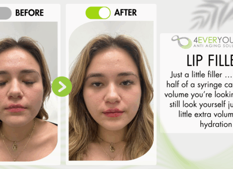 lip filler