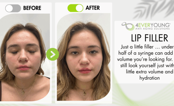  Enhance Your Natural Beauty with Lip Filler at 4Ever Young Ramsey 