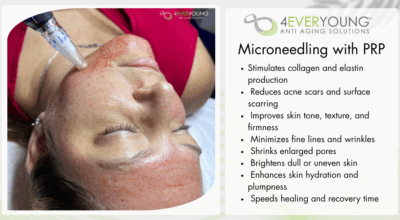microneedling with PRP