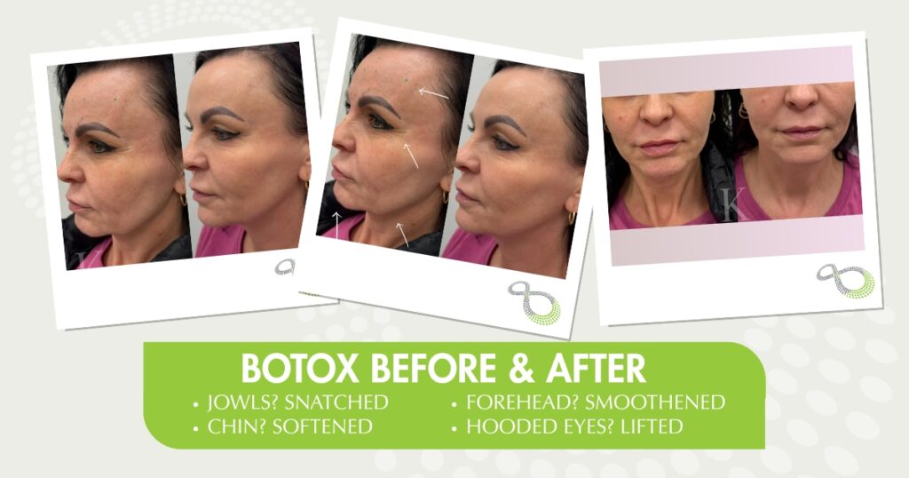 Botox results Ridgewood NJ 4Ever Young anti-aging solutions