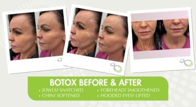 Botox results Ridgewood NJ 4Ever Young anti-aging solutions