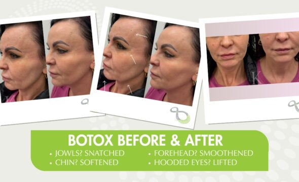Botox Before and After in Ridgewood: From Forehead to Jawline, Here’s What Changes