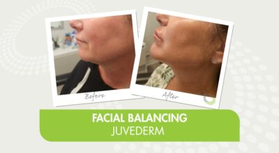 Juvederm 4Ever Young San Antonio med spa