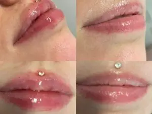 Lip Enhancement