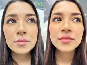 Lip Enhancement
