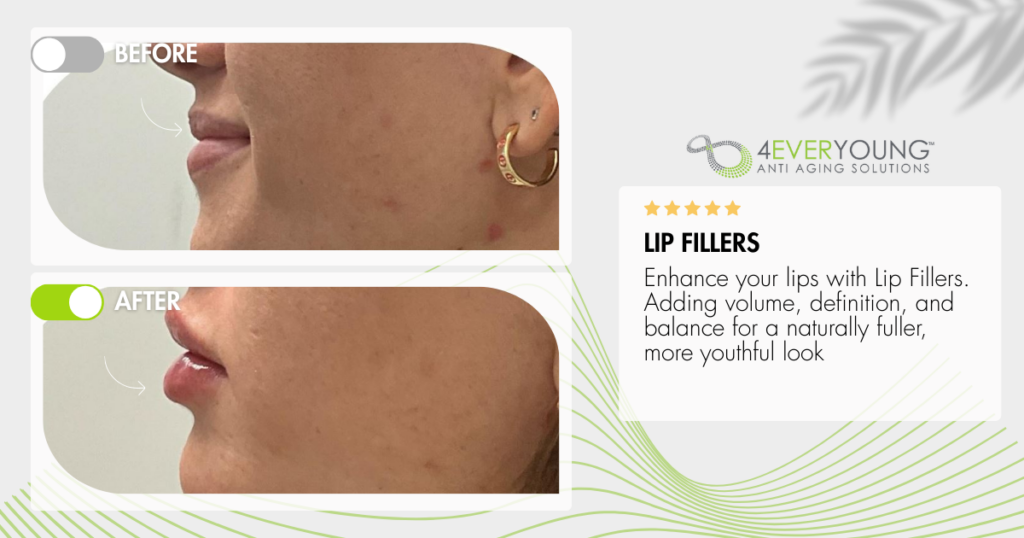 Lip Filler