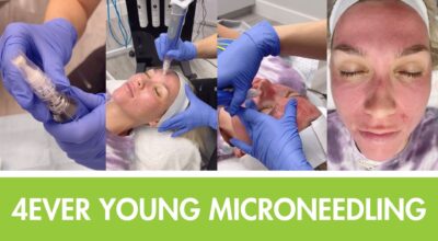 microneedling