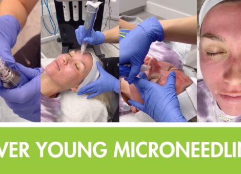microneedling