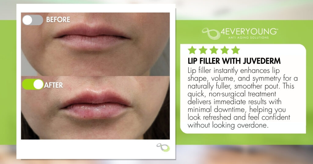 Juvederm lip fillers Loudoun 4Ever young anti-aging solutions medspa