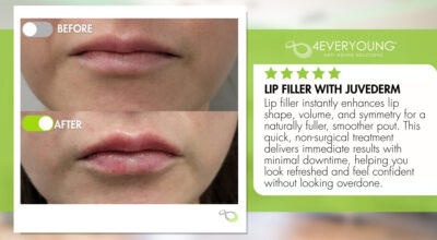 Juvederm lip fillers Loudoun 4Ever young anti-aging solutions medspa