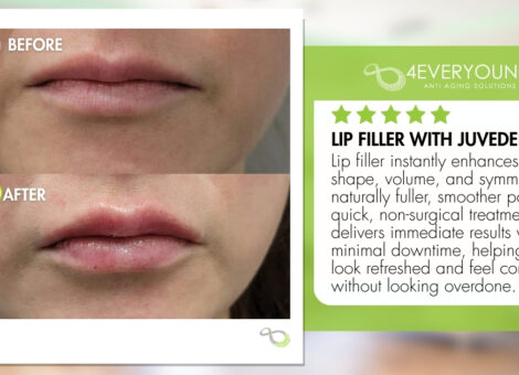 Juvederm lip fillers Loudoun 4Ever young anti-aging solutions medspa