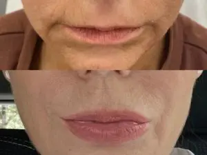 Lip Enhancement