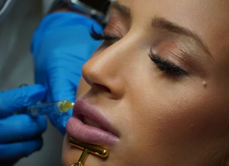 A gloved provider injects hyaluronic acid filler into a patient's upper lip