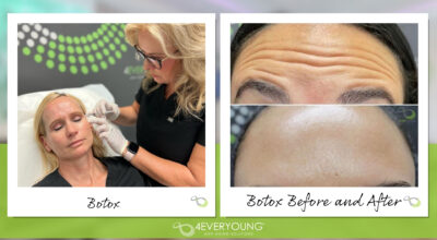 botox near me wilchester