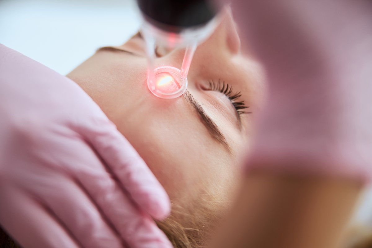 IPL photofacial treatment